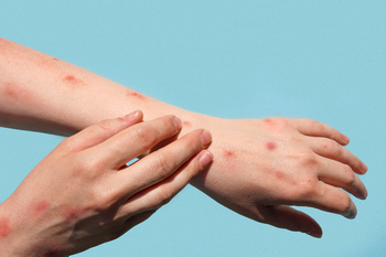 OGN's VTAMA Cream Shows Sleep Benefits in Pediatric Atopic Dermatitis: https://staticx-tuner.zacks.com/images/articles/main/d9/74627.jpg